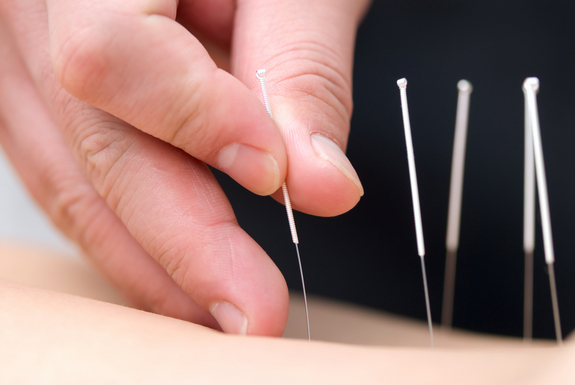 A person giving acupuncture treatment